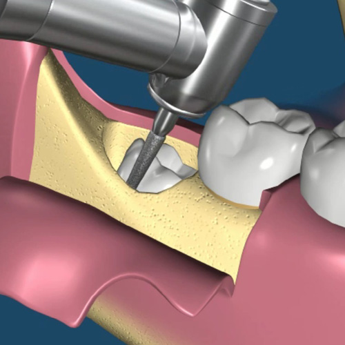 implantologia-studio-donadio-napoli-chirurgia-orale