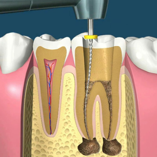 implantologia-studio-donadio-napoli-endodonzia