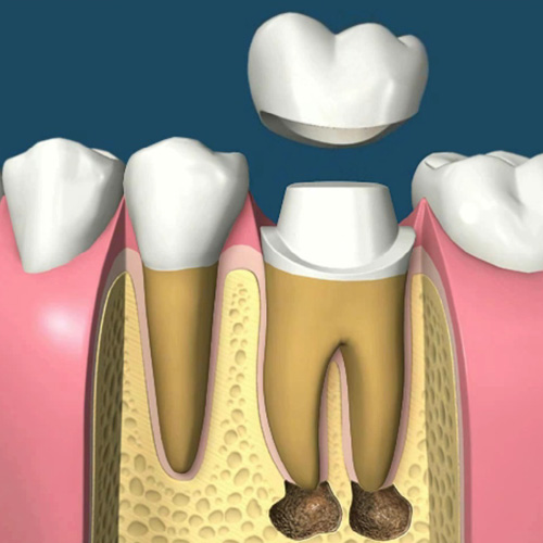 implantologia-studio-donadio-napoli-endodonzia
